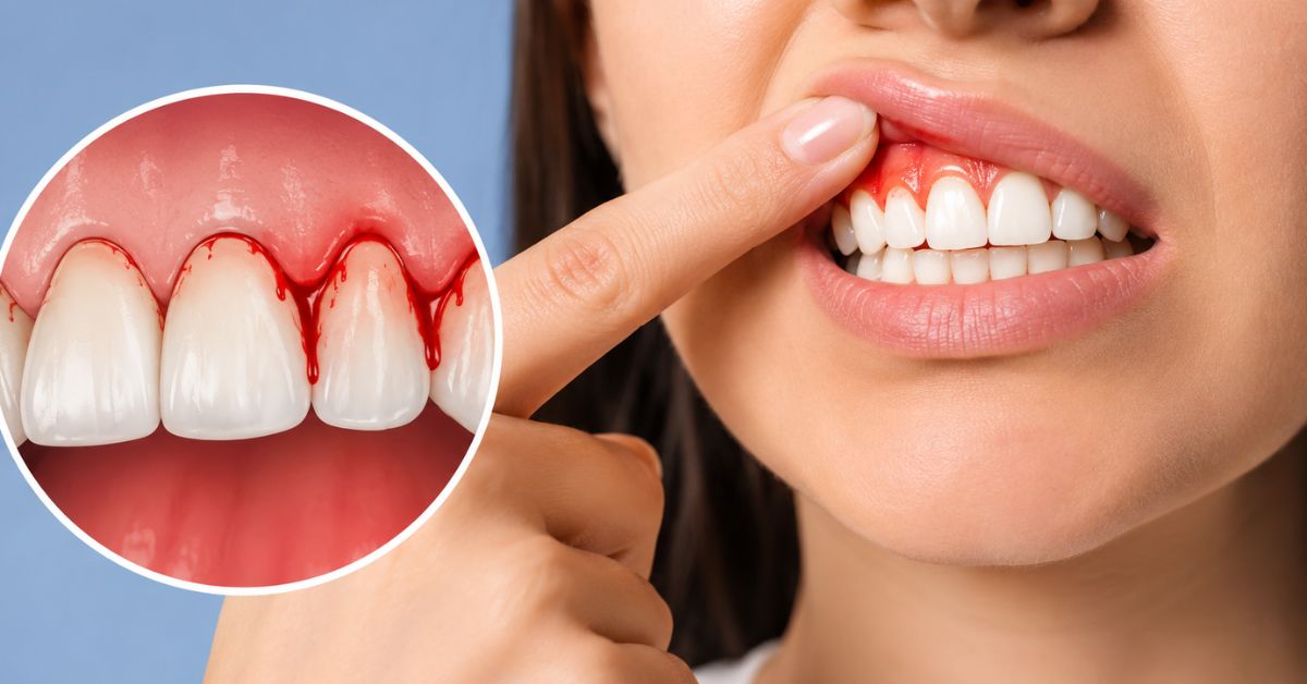 Bleeding Gums